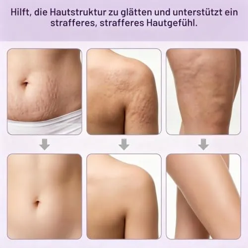 SINZONeu Anti-Cellulite Massagegerät 4